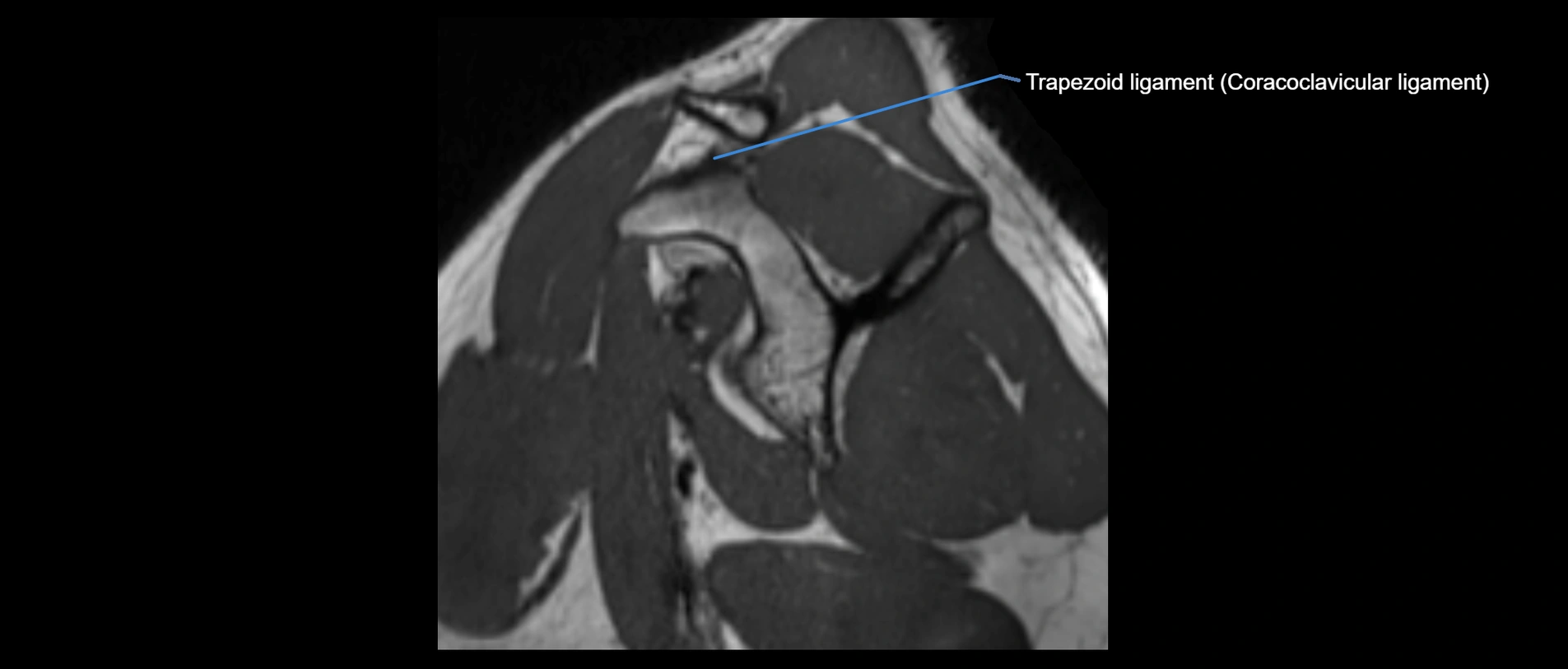 shoulder ligaments sagittal  cross sectional anatomy 3T MRI AI enhanced radiology image -img-00001-00019.webp